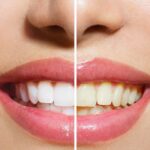Brighter Smiles with Expert Teeth Whitening Balmain