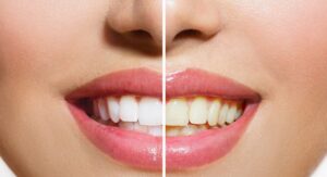 Brighter Smiles with Expert Teeth Whitening Balmain
