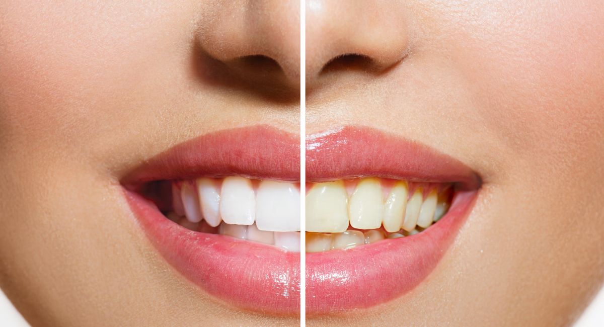 Brighter Smiles with Expert Teeth Whitening Balmain